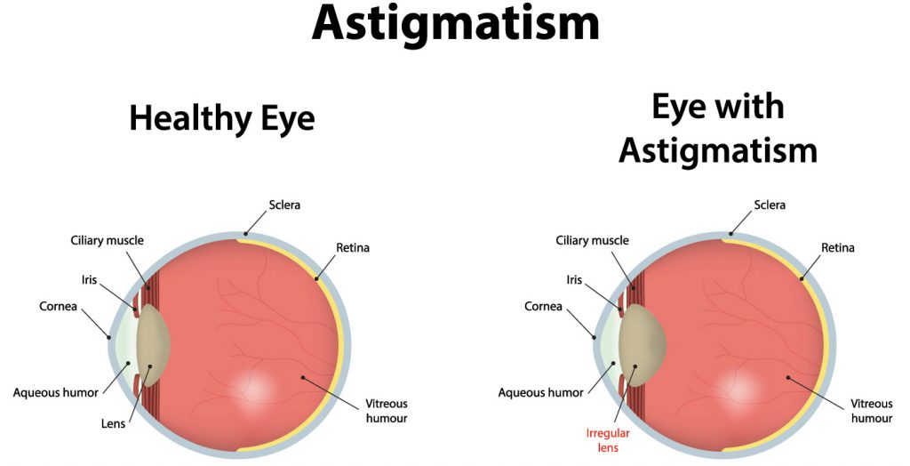 Astigmatism